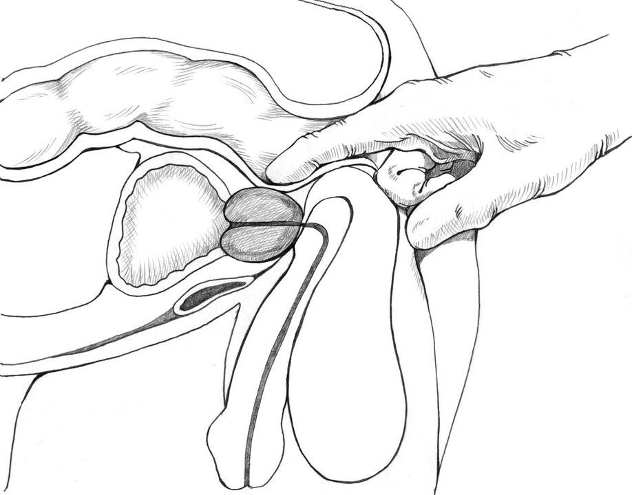 Prostatos masažas yra įtrauktas į prostatito gydymo metodų kompleksą